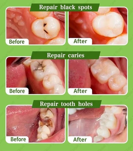 Dental cement tooth repair - cement,